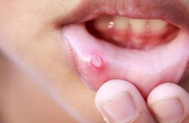 Afte, infezione alla bocca (Pinterest)