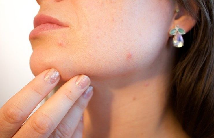 acne rimedi naturali