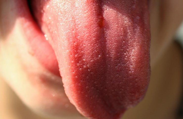 lingua carenza vitaminica 