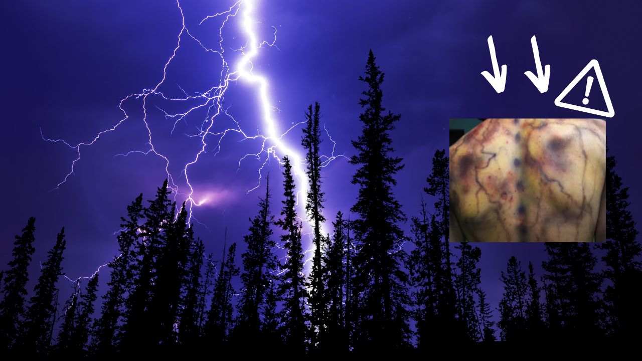 Colpito 7 volte fulmine storia record