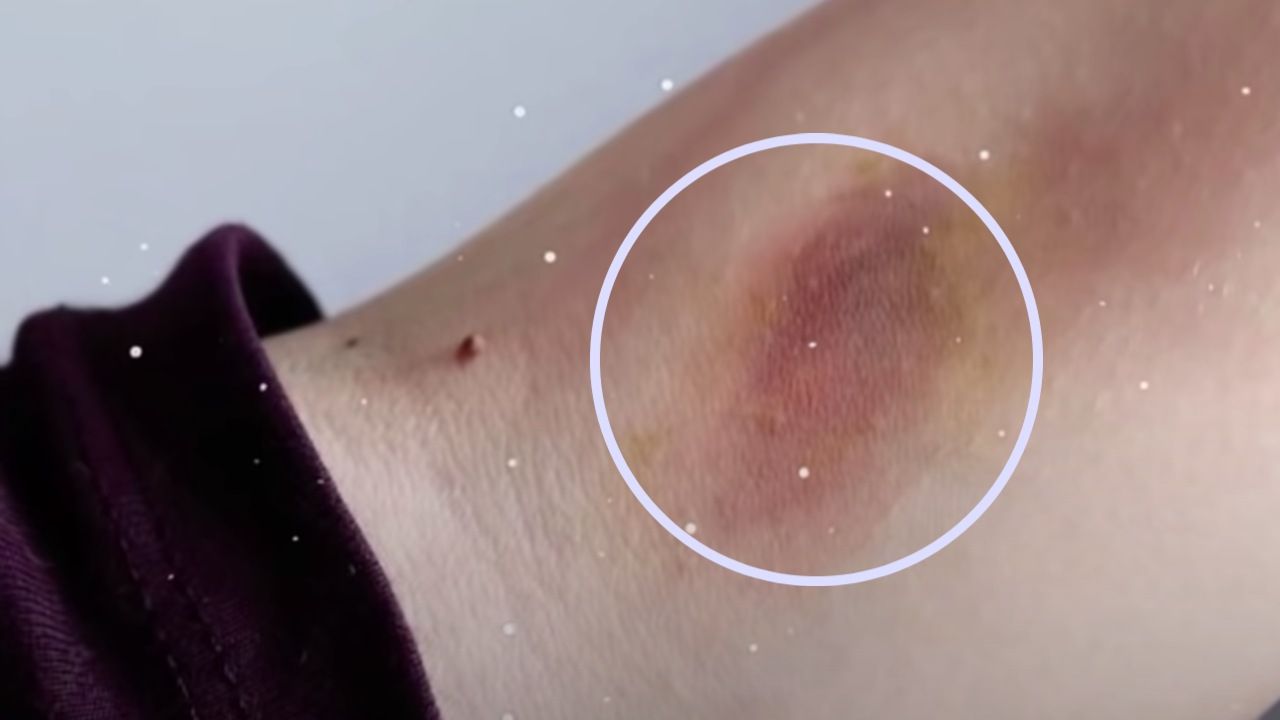 reazioni punture insetti