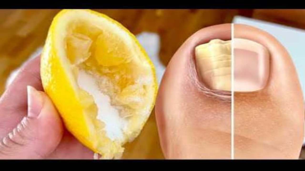 Funghi alle unghie dei piedi