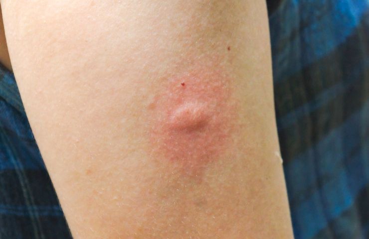 Puntura zanzare fermare prurito metodo 