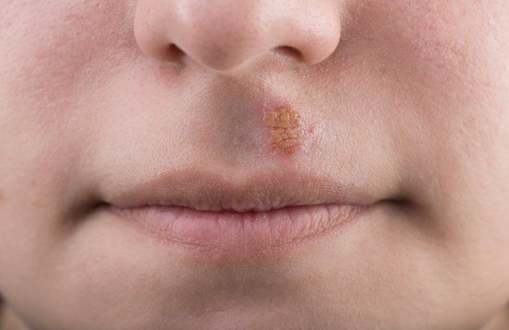 herpes sporco infezione 